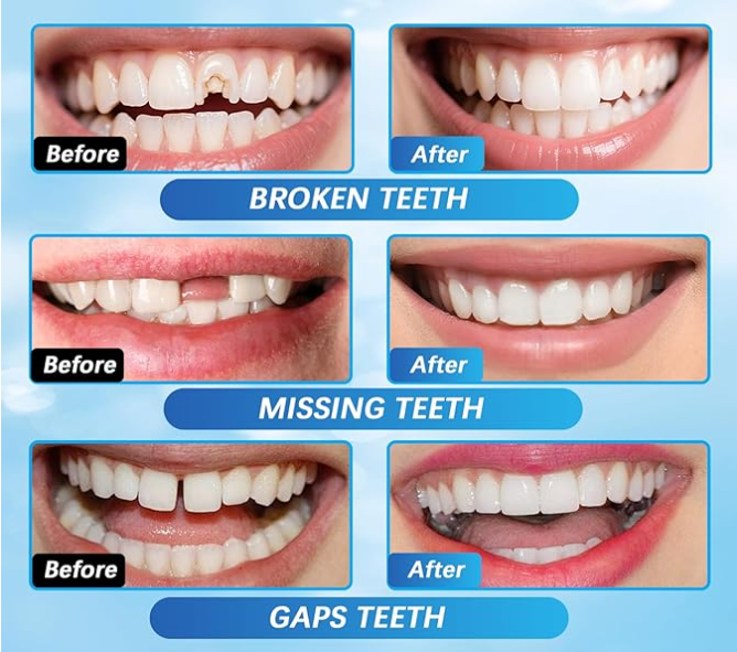 PearlPatch Temporary Smile Repair Kit